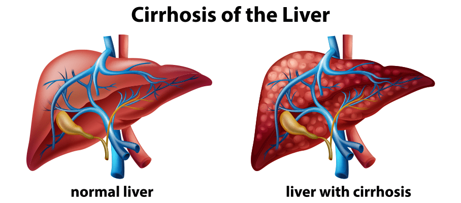 Liver Cirrhosis treatment in Thane and Mulund